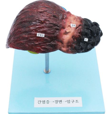 간의 이상모형(간병변)